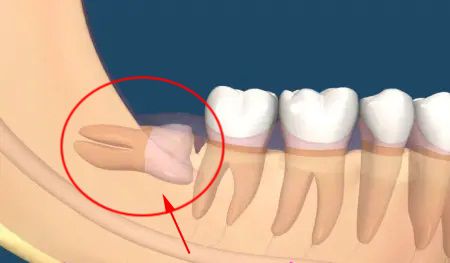 很多人不知道，智牙這樣拔才科學！